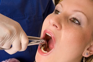 Oral Surgery tooth extraction