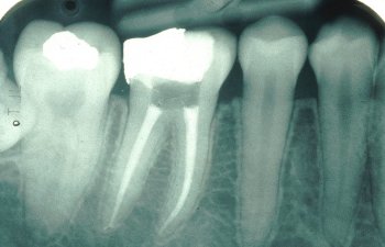 Root canal X-ray