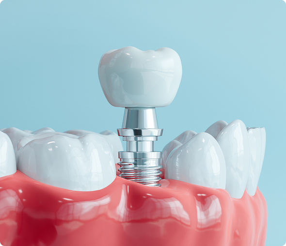 Prosthetic tooth in gum model