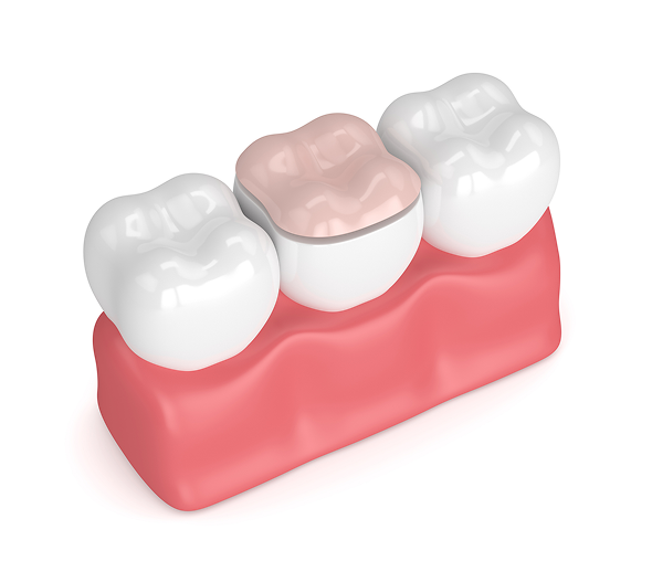 Tooth crown on gum model