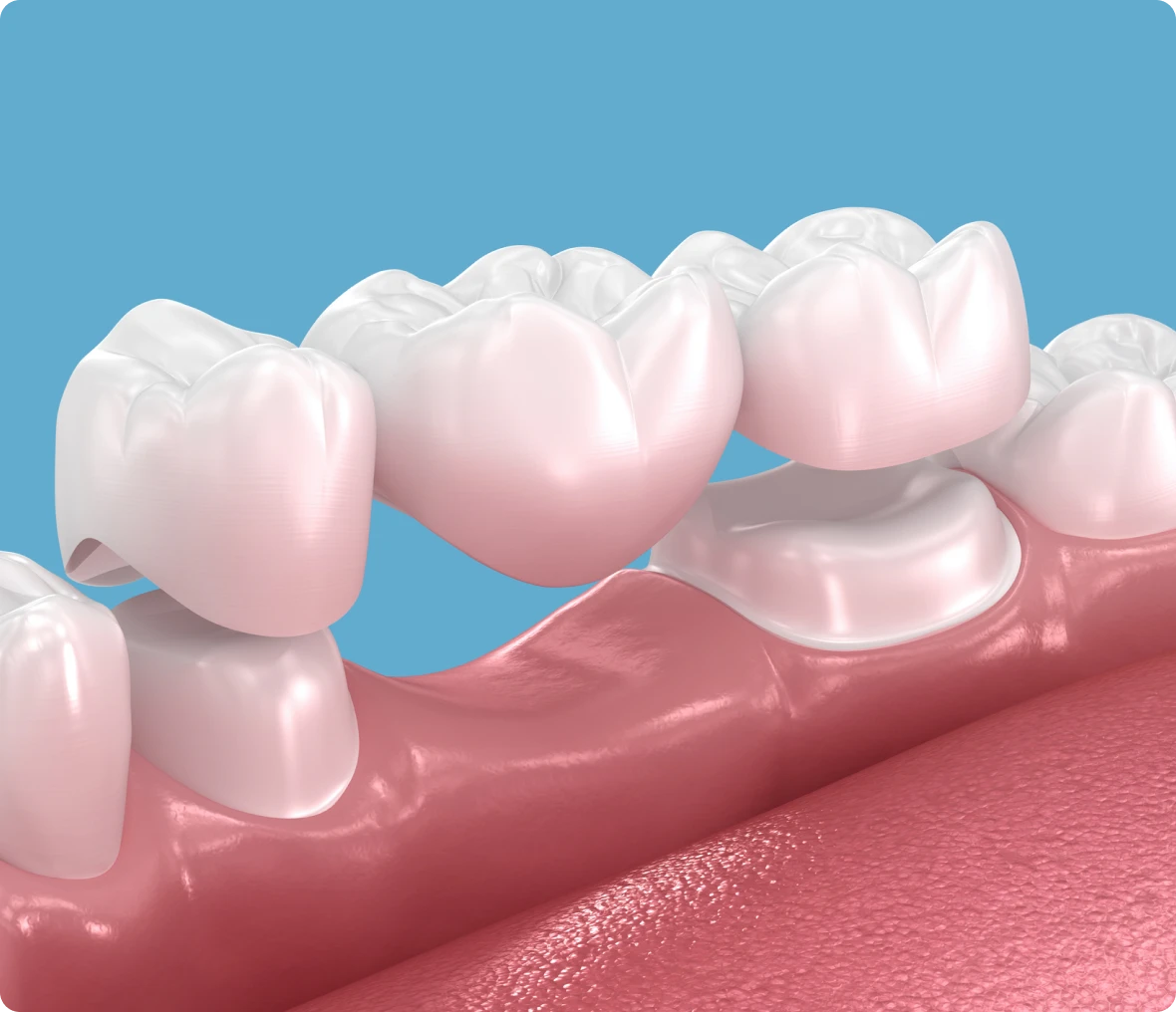 Close-up of dental crown placement